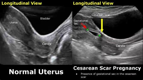 ultrasound measurement of cesarean scar thickness|cesarean section ultrasound uk.